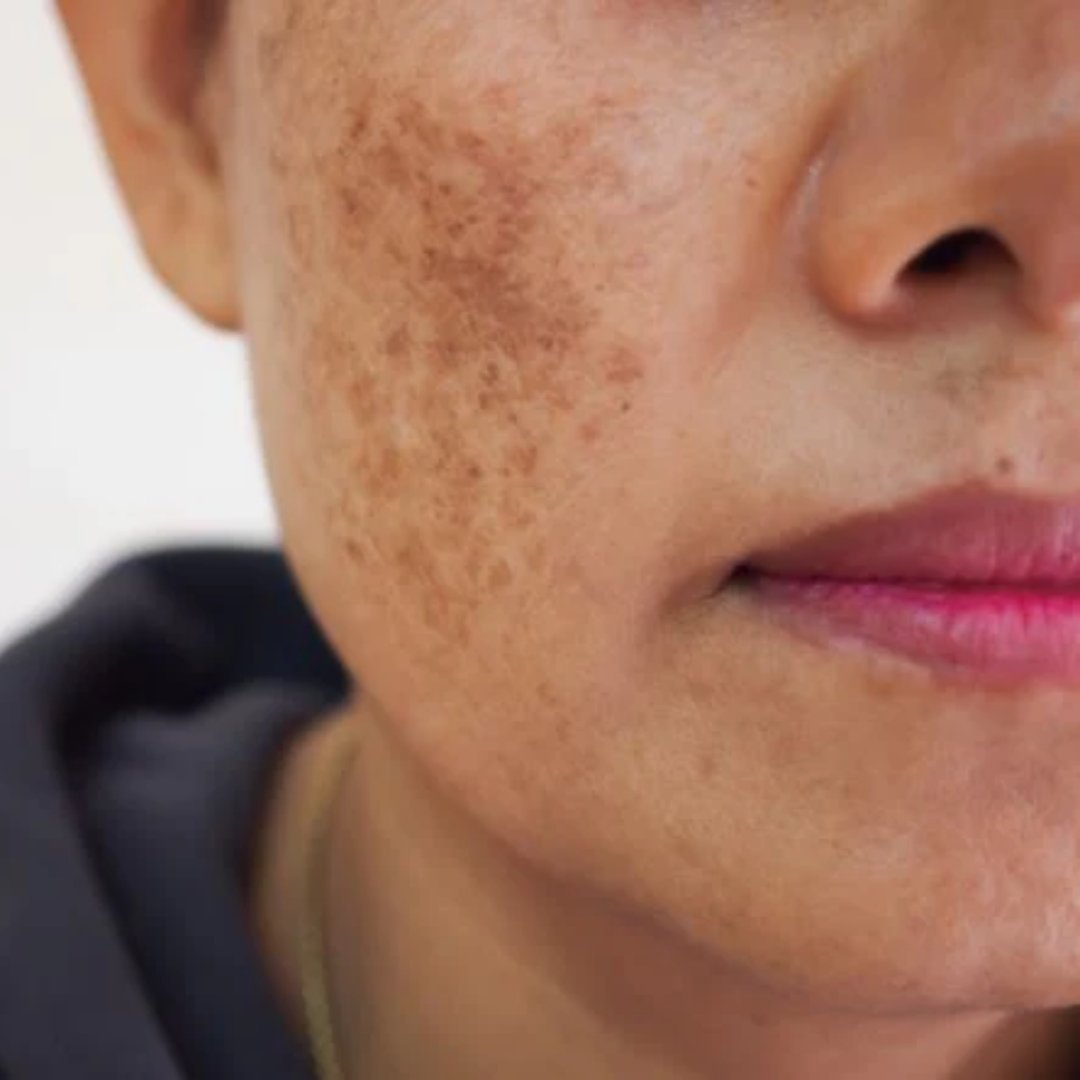 Pigmentation and Dark Spots