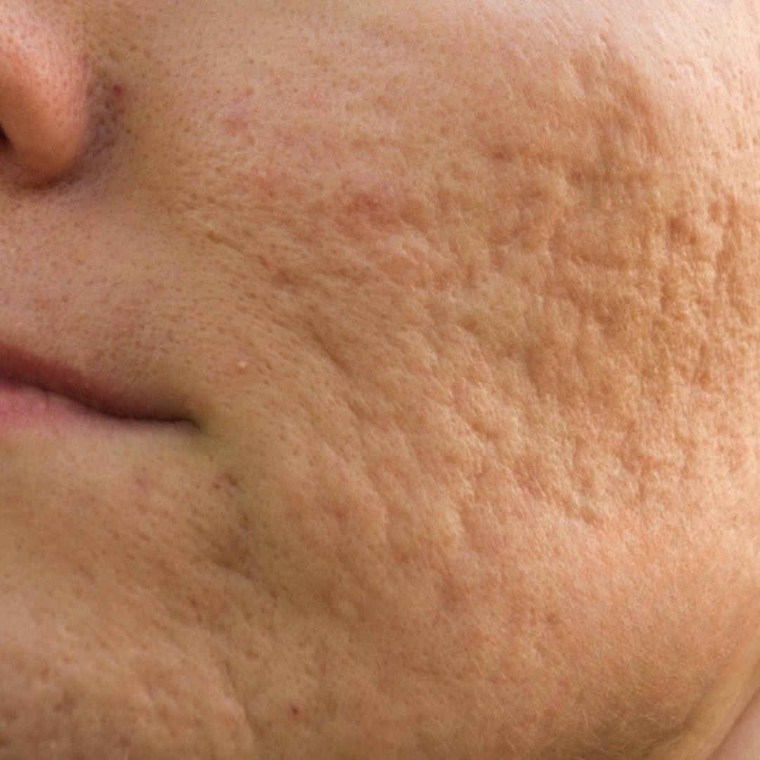 Acne & Skin Resurfacing